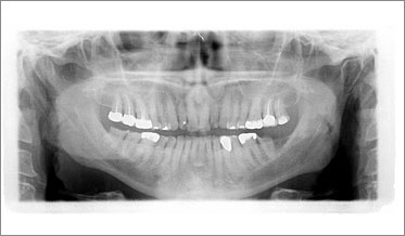 Innovative Staged Treatment of a Worn Dentition